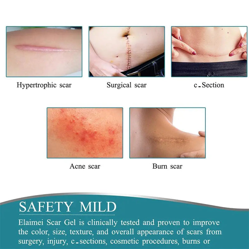 150cm Silicone Gel Scar Sheet Patch Treatment Removal Tape Acne Trauma Burn Scar Cover Skin Repair Section Ear Beauty