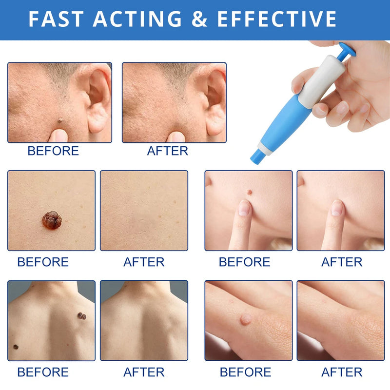 2 IN 1 Auto Micro Skin Tag Remover Device Standard And Micro Skin Tag Removal Kit Adult Mole Wart Remover Face Care Beauty Tools