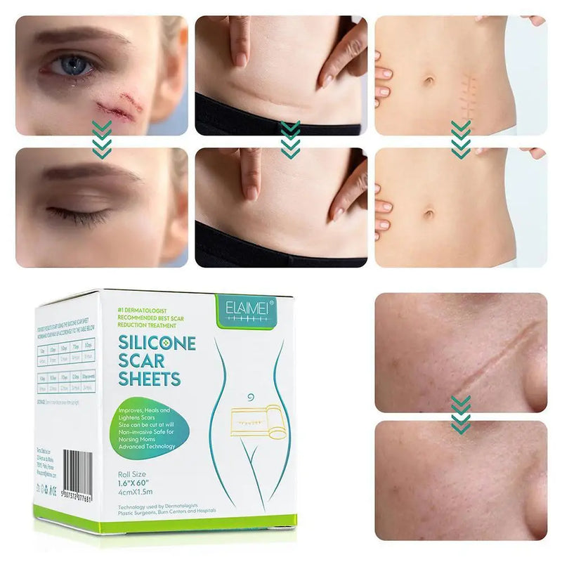 150cm Silicone Gel Scar Sheet Patch Treatment Removal Tape Acne Trauma Burn Scar Cover Skin Repair Section Ear Beauty