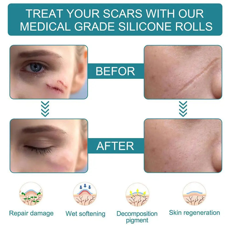 150cm Silicone Gel Scar Sheet Patch Treatment Removal Tape Acne Trauma Burn Scar Cover Skin Repair Section Ear Beauty